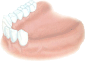 implant dentaire dentiste marseille implantologie 3