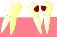 perte dent  dentiste marseille protheses dentaires  CARIES 4